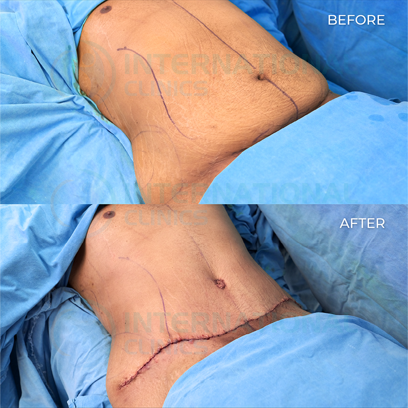 Abdominoplastie 